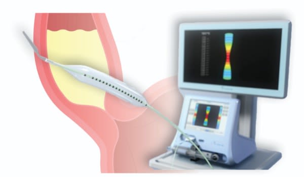 endoluminal functional lumen imaging probe (EndoFLIP) during a procedure